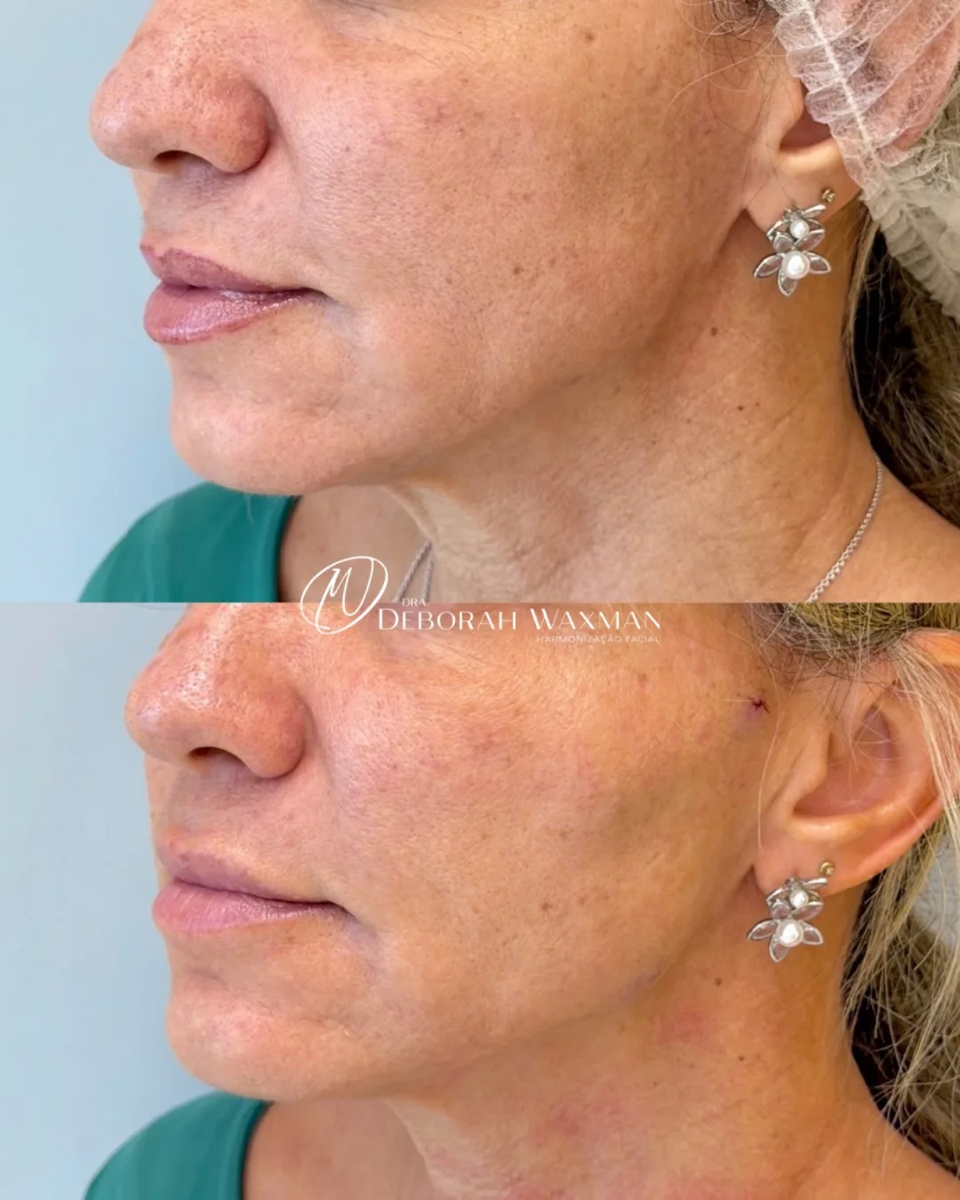 Antes e depois de contorno facial e rejuvenescimento do perfil