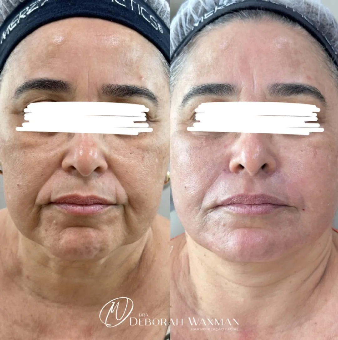 Antes e depois de Full Face, avaliação global do rosto