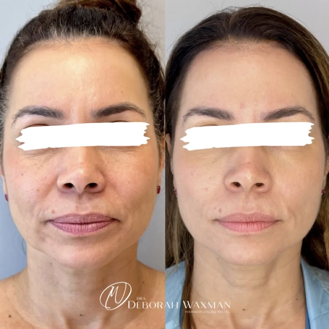 Antes e depois de harmonização facial