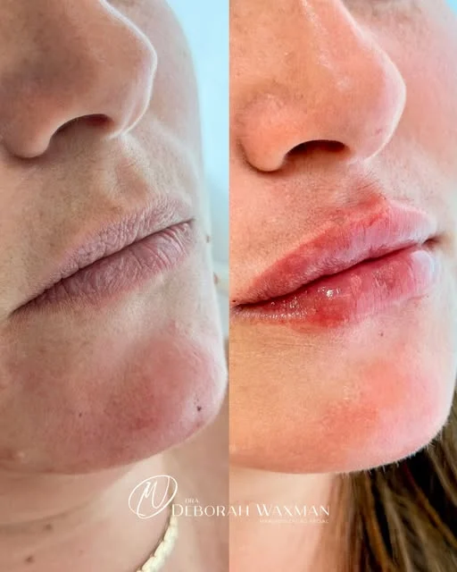 Antes e depois de preenchimento labial com contorno e hidratação