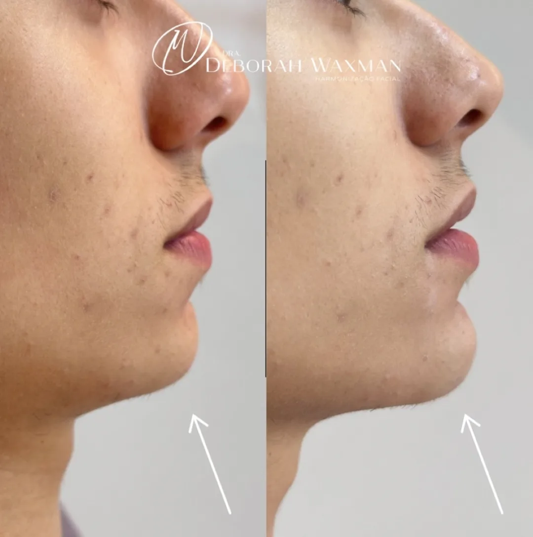 Antes e depois de harmonização do contorno mandibular
