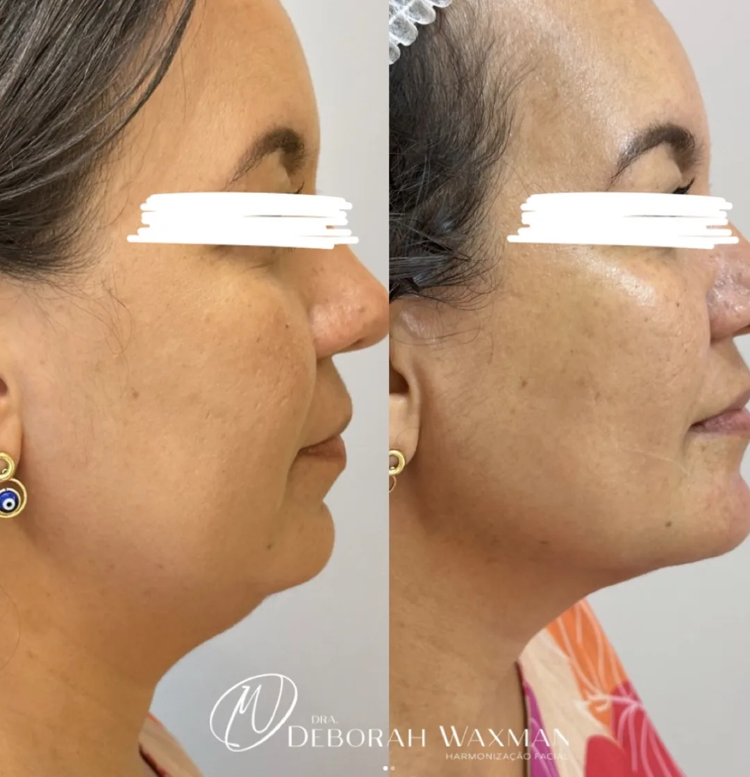Antes e depois de definição do mento e perfil mandibular