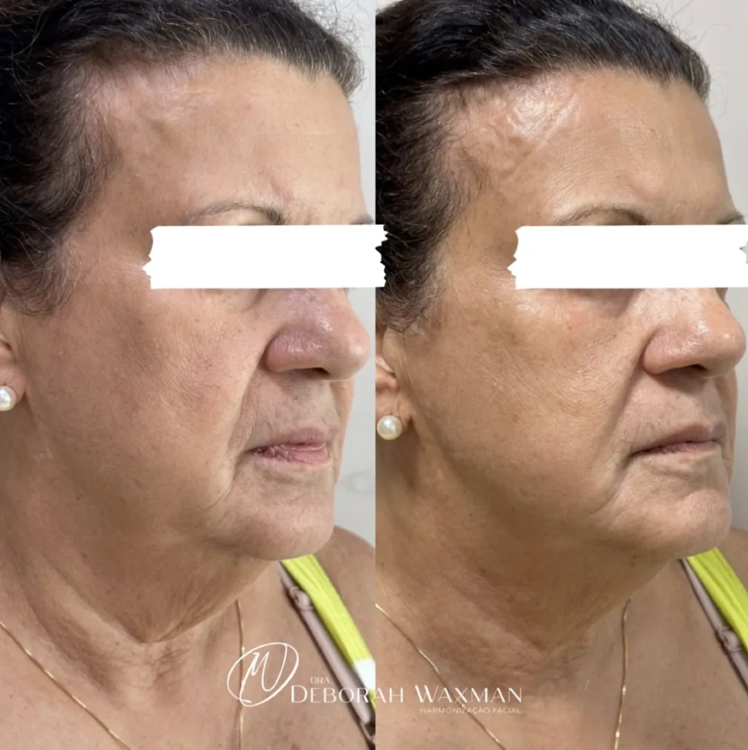 Antes e depois de rejuvenescimento facial multicamadas