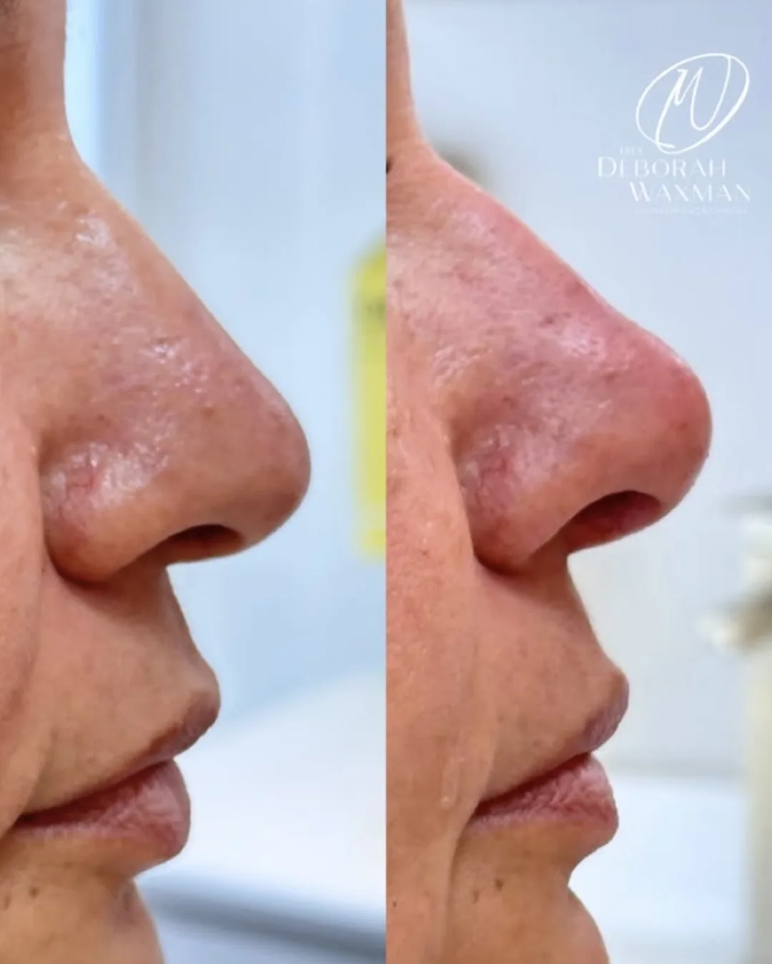 Antes e depois de refinamento do contorno do nariz