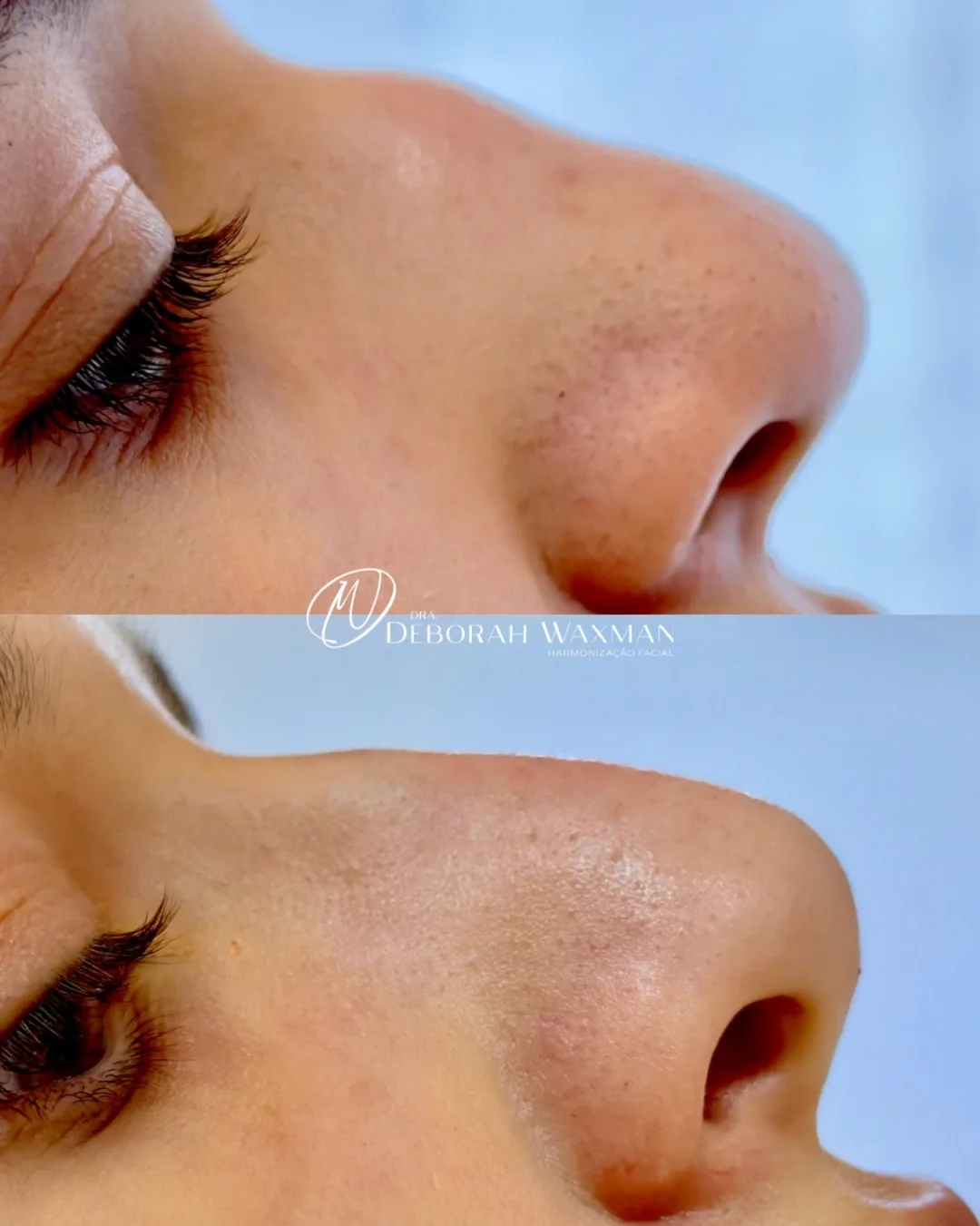 Antes e depois de rinomodelação, refinamento do nariz sem cirurgia