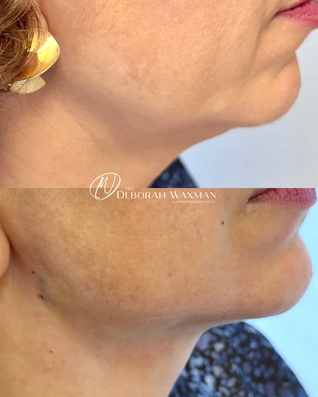 Antes e depois de definição do contorno cervical e do pescoço